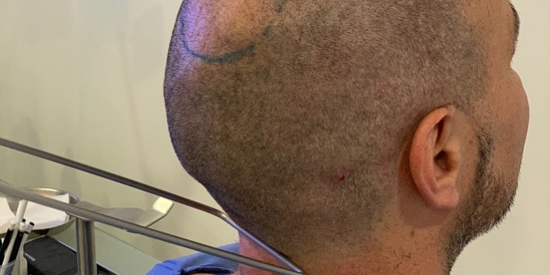 Diseño de injerto capilar en un hombre