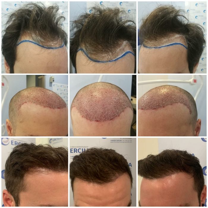 Antes y Después Cirugía Capilar