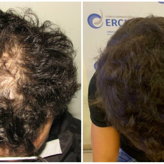 Antes y Después Clínica Capilar